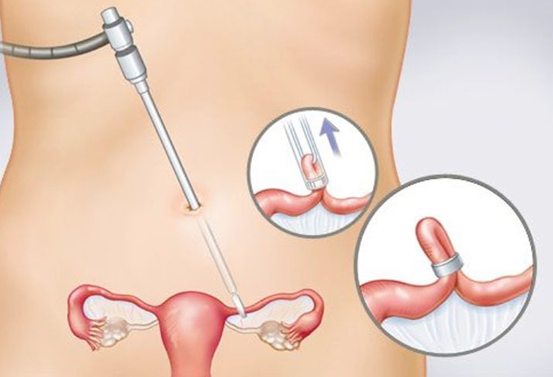 Phòng tránh thai: Các phương pháp hiệu quả và an toàn nhất 20 triet san nu